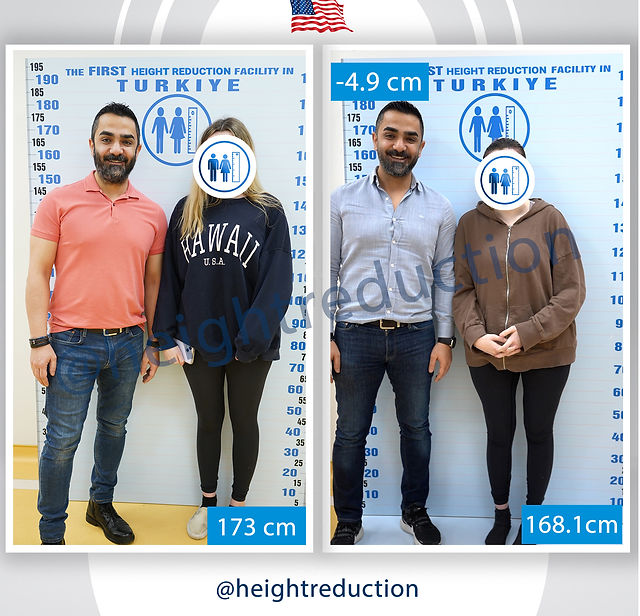 Would you get height reduction surgery? Forums